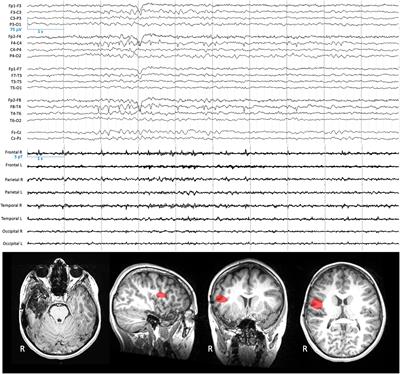 Tri-axial rubidium and helium optically pumped magnetometers for on-scalp magnetoencephalography recording of interictal epileptiform discharges: a case study